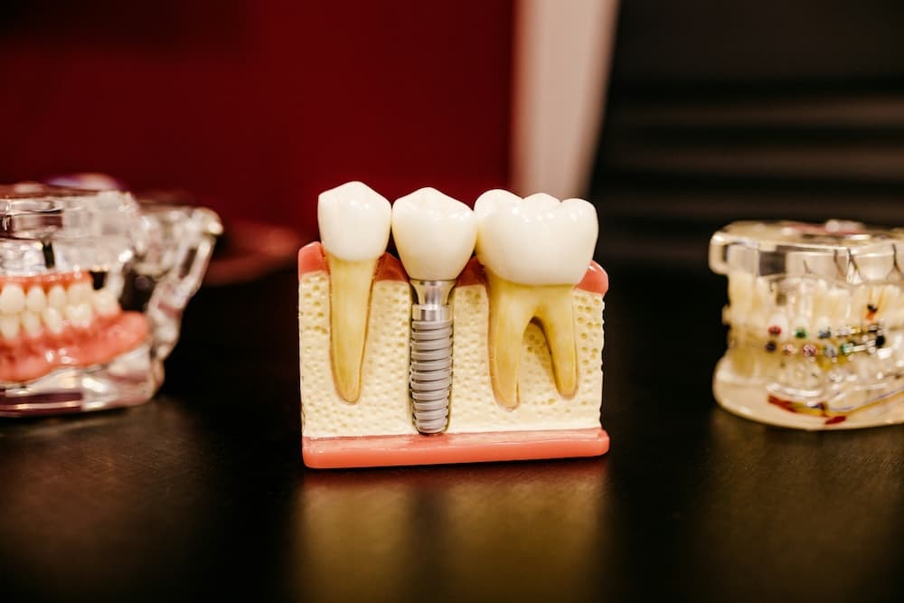 Implant Dentistry